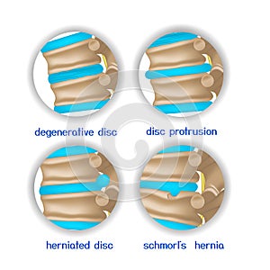 Spine diseases. Various pathologies of intervertebral discs and bones. photo